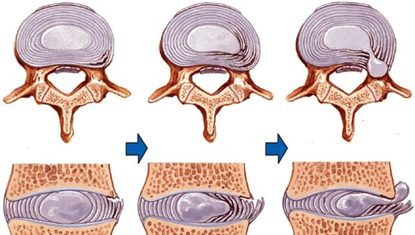 lesión da columna na osteocondrose