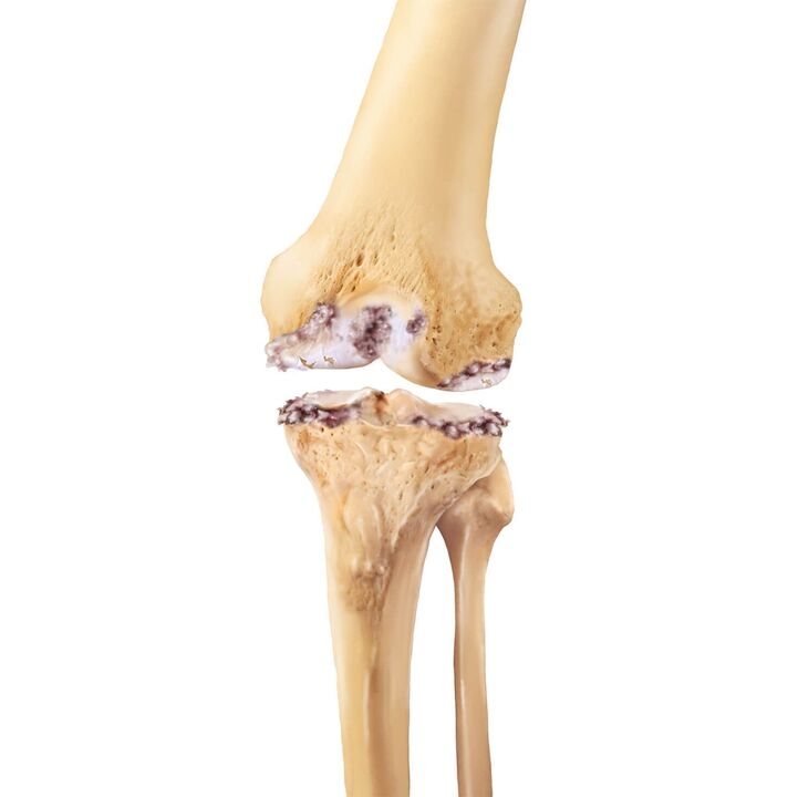 destrución da articulación do xeonllo con artrose