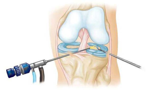 Na última fase do desenvolvemento, a artrose é tratada cirurxicamente