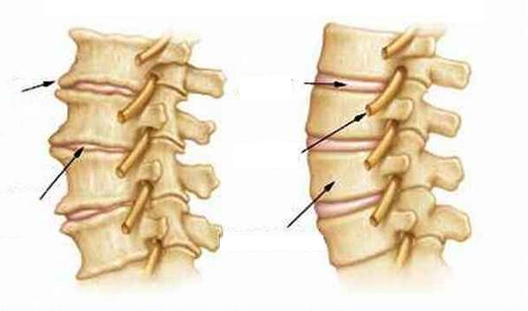 Que é a osteocondrose