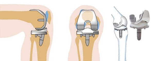 Funcionamento de endoprótese da articulación do xeonllo para a artrose