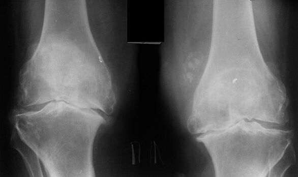 X -ray como forma de diagnosticar a artrose da articulación do xeonllo