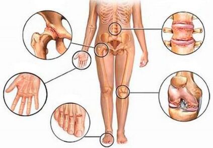 Artrite e artrose de varias articulacións