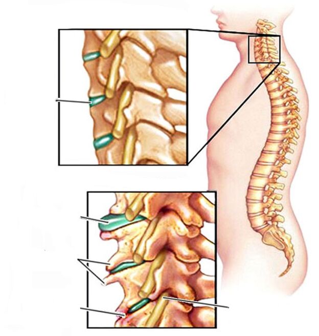 osteocondrose e unha columna cervical sa
