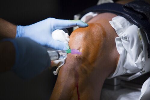 Inxeccións na articulación do xeonllo por artrose
