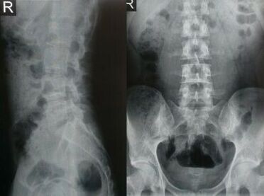 radiografía da columna lumbar